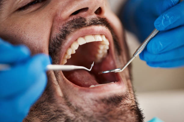 Best Chipped Tooth Repair Near Me  in Riverdale, GA